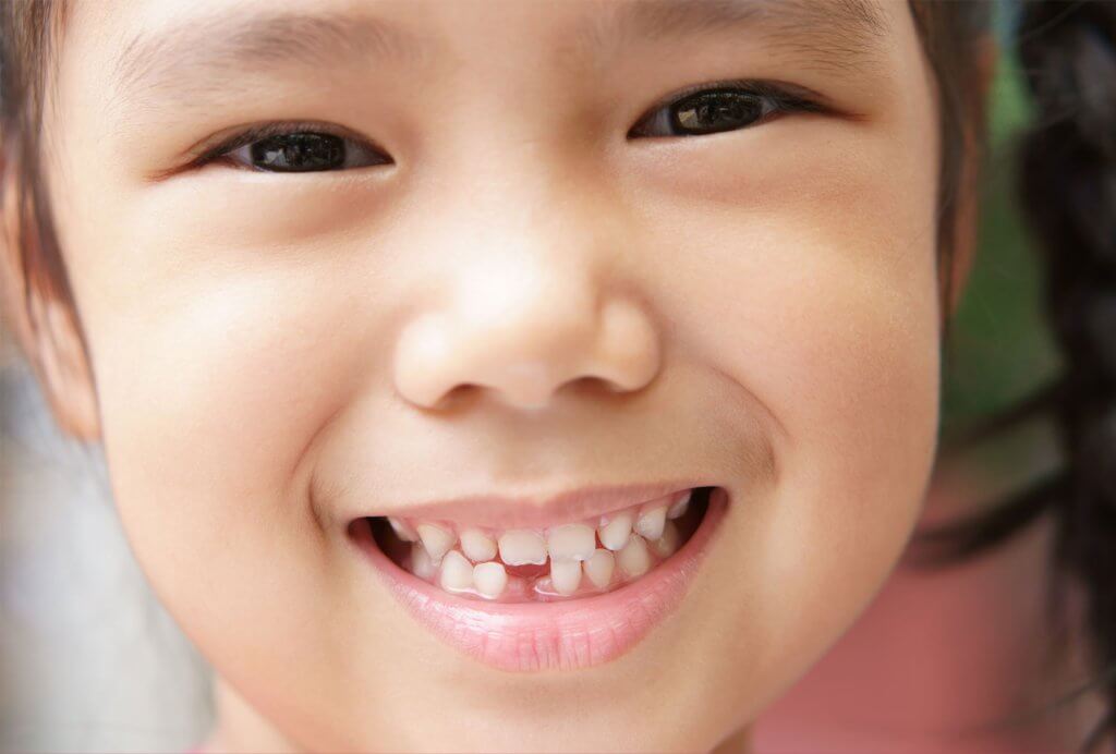 Child with a Chipped Tooth that can be treated by pediatric dentists at Pediatric Smiles of Orem