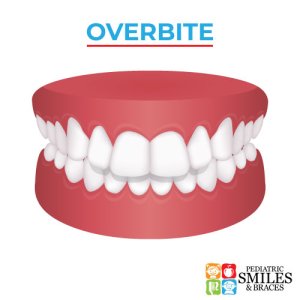 Pediatric Smiles graphic depicting an overbite