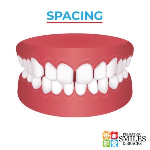 Pediatric Smiles graphic depicting dental spacing