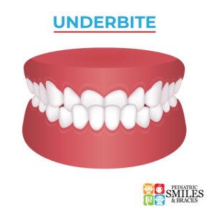 Pediatric Smiles graphic depicting an underbite