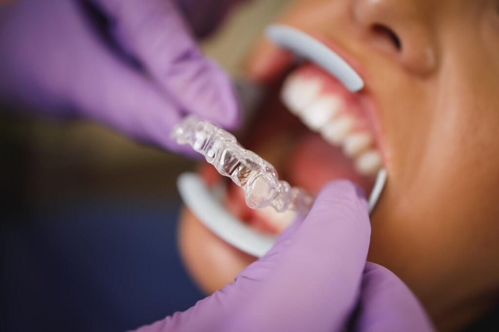 Dentist from Pediatric Smiles fitting Invisalign to a patient.