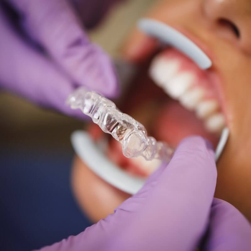 Dentist from Pediatric Smiles fitting Invisalign to a patient.